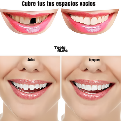 CARILLAS DENTALES ESTETICAS SnapOn®